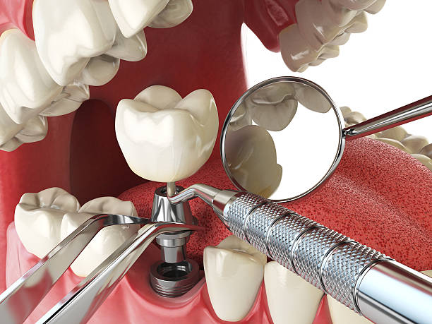 Best Dentist for Tooth Abscess  in Lake St Louis, MO